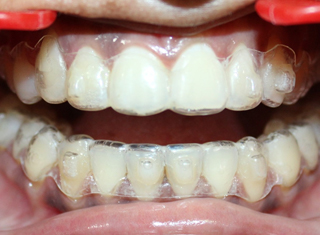 dent1