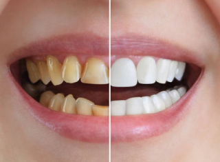 dent1