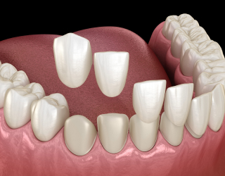 dent1