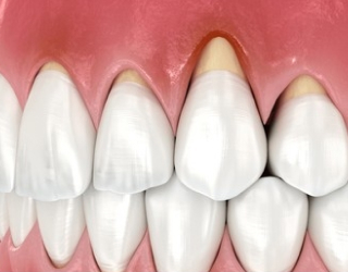 dent1
