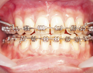 dent1