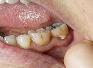 dent1
