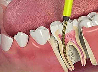 dent1