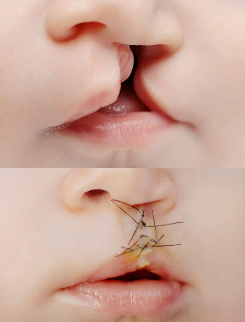 cleftpalatecleftLip