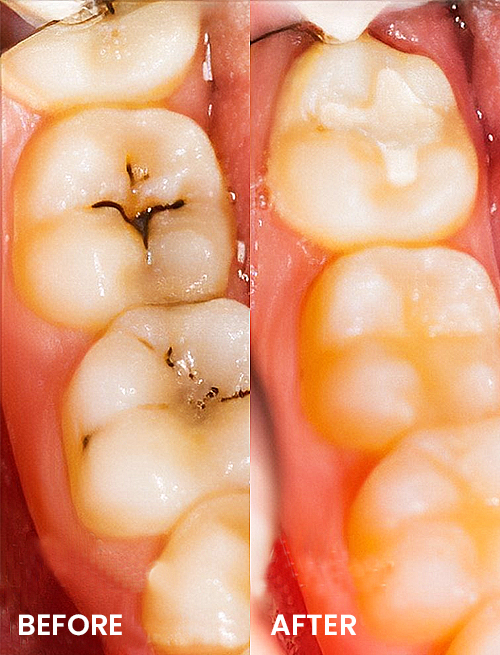 dentalselants