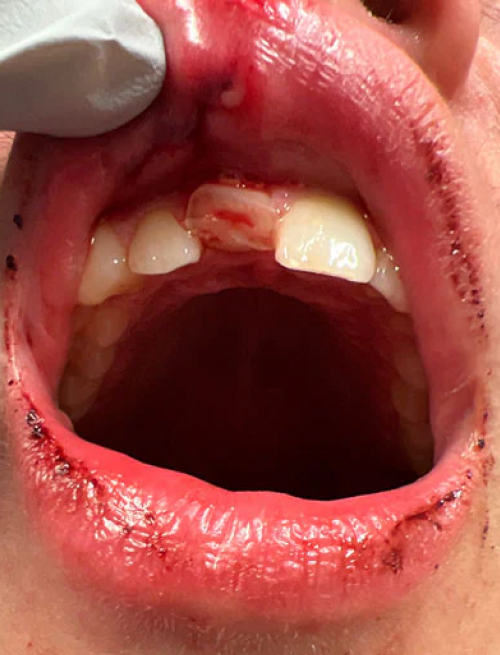dentaltrauma