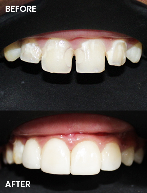fillings