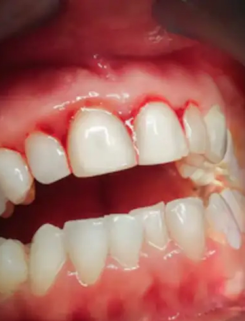gingivectomy