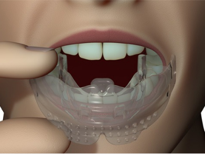 myobrace
