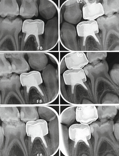 pulpectomy