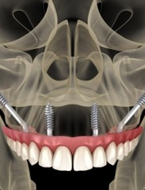 zygoma-implant