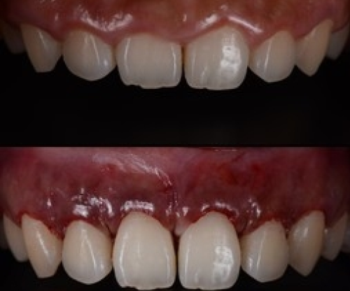 dent1