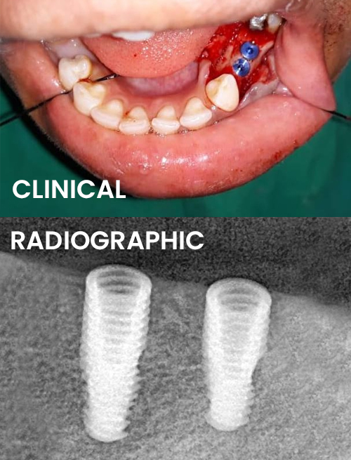 implanting