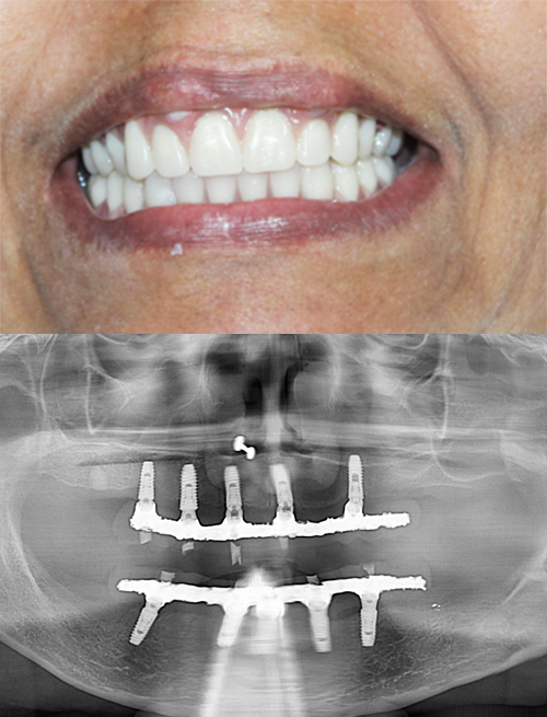 fullmouth