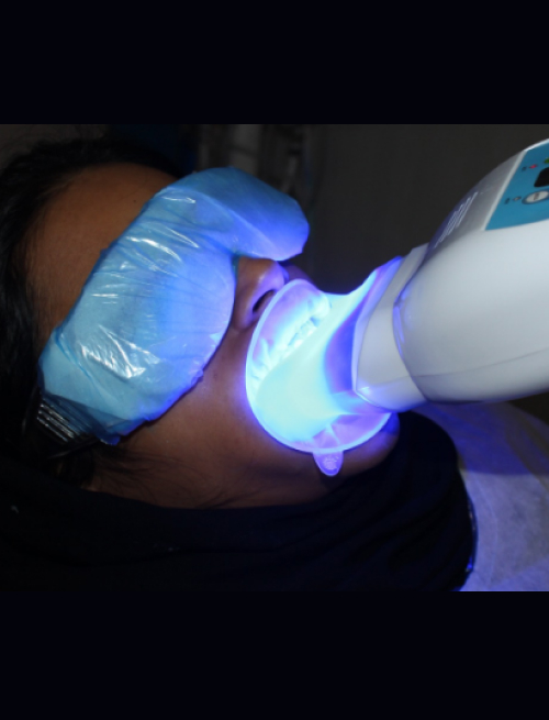 teethwhitening