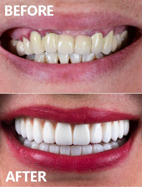 veneer