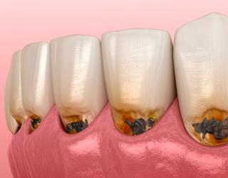 dent1